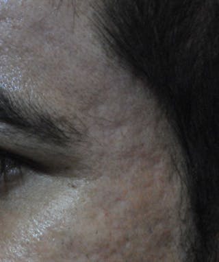 Acne Scar Treatment Before & After Gallery - Patient 250389 - Image 8