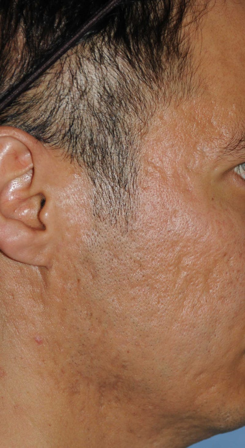 Acne Scar Treatment Before & After Gallery - Patient 250389 - Image 9