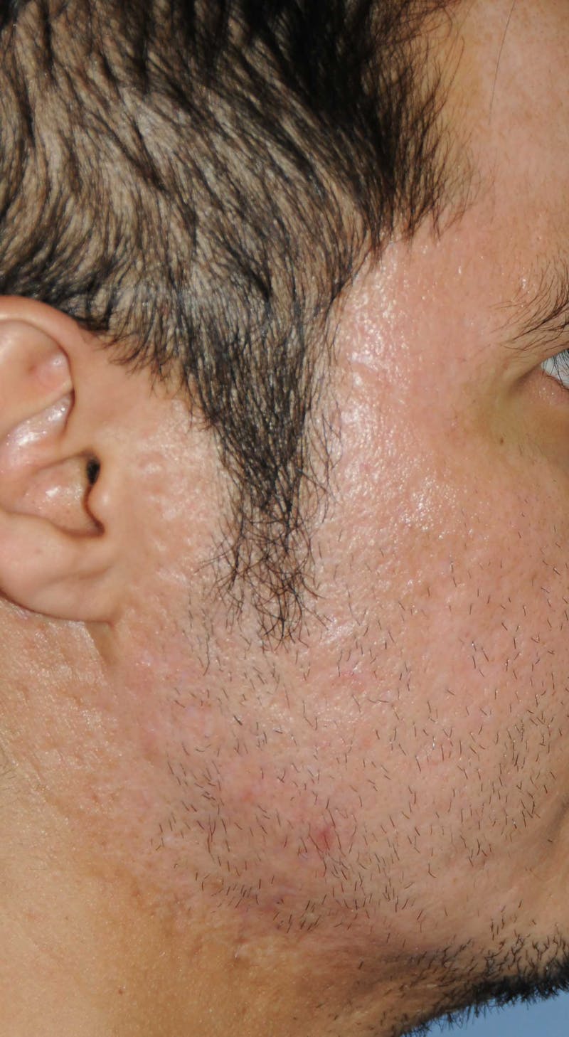 Acne Scar Treatment Before & After Gallery - Patient 250389 - Image 10