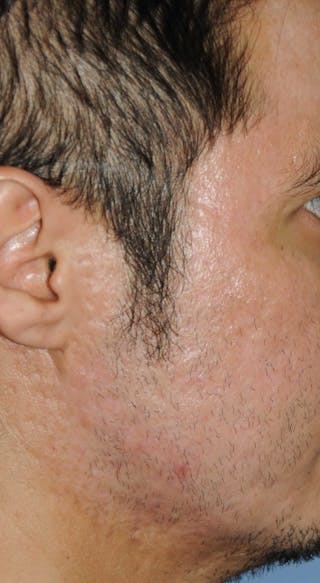 Acne Scar Treatment Before & After Gallery - Patient 250389 - Image 10