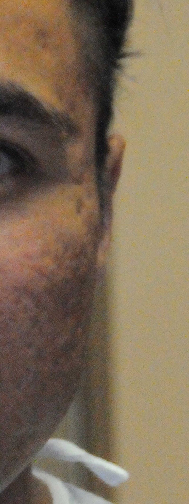 Acne Scar Treatment Before & After Gallery - Patient 250389 - Image 11