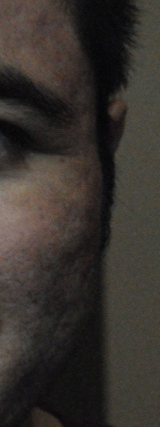 Acne Scar Treatment Before & After Gallery - Patient 250389 - Image 12