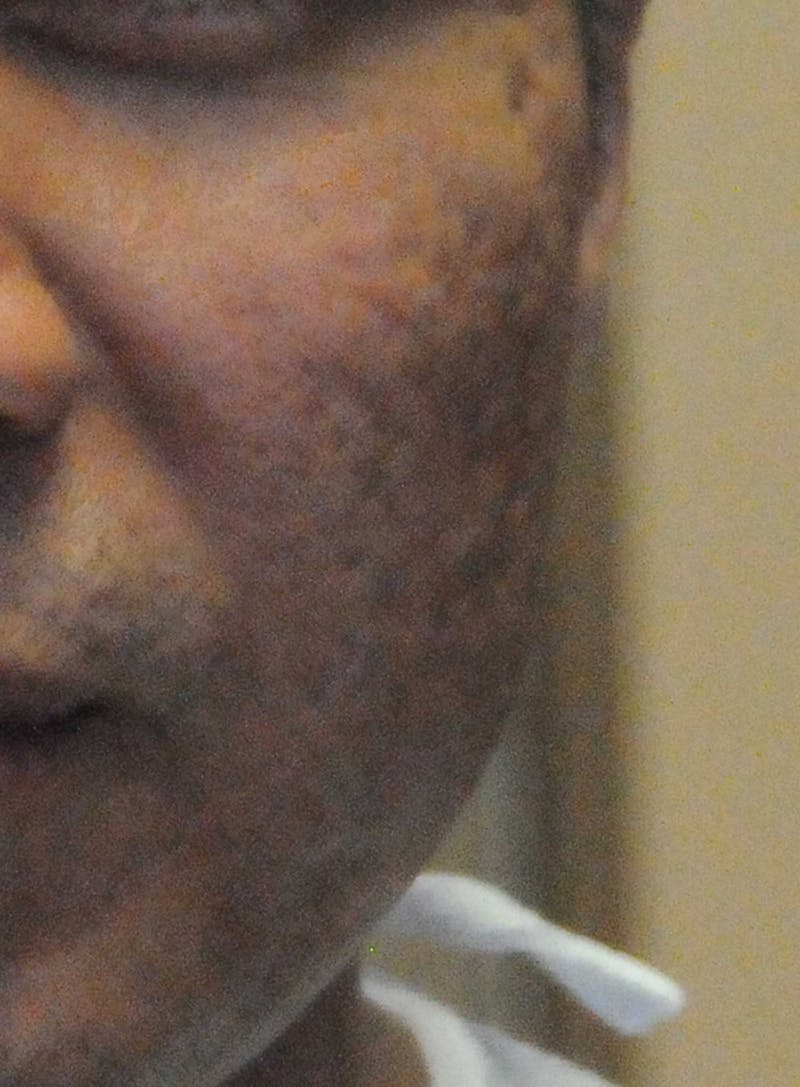 Acne Scar Treatment Before & After Gallery - Patient 250389 - Image 13