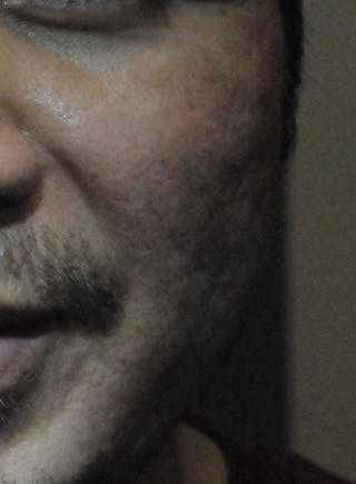 Acne Scar Treatment Before & After Gallery - Patient 250389 - Image 14