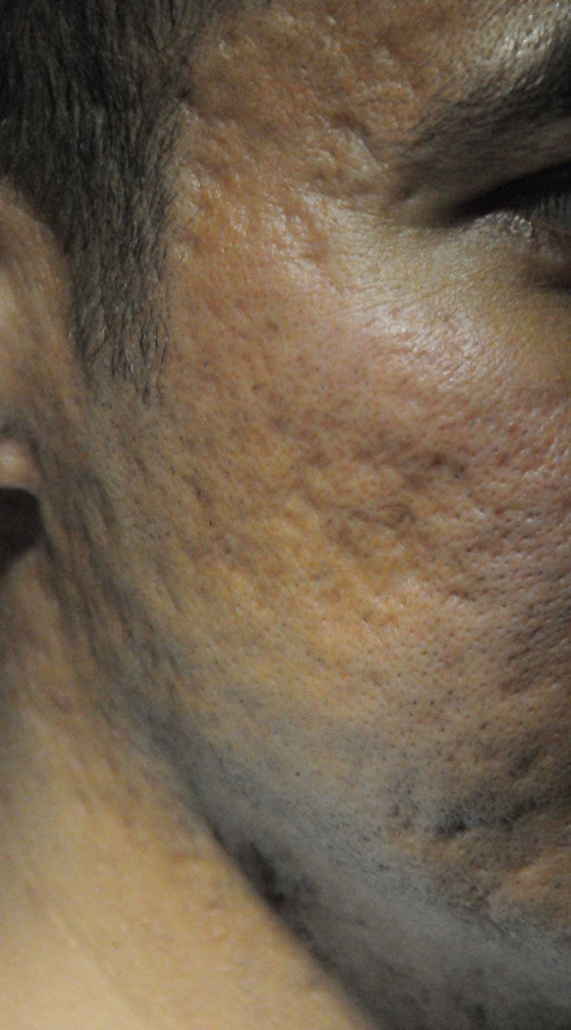 Acne Scar Treatment Before & After Gallery - Patient 250389 - Image 15