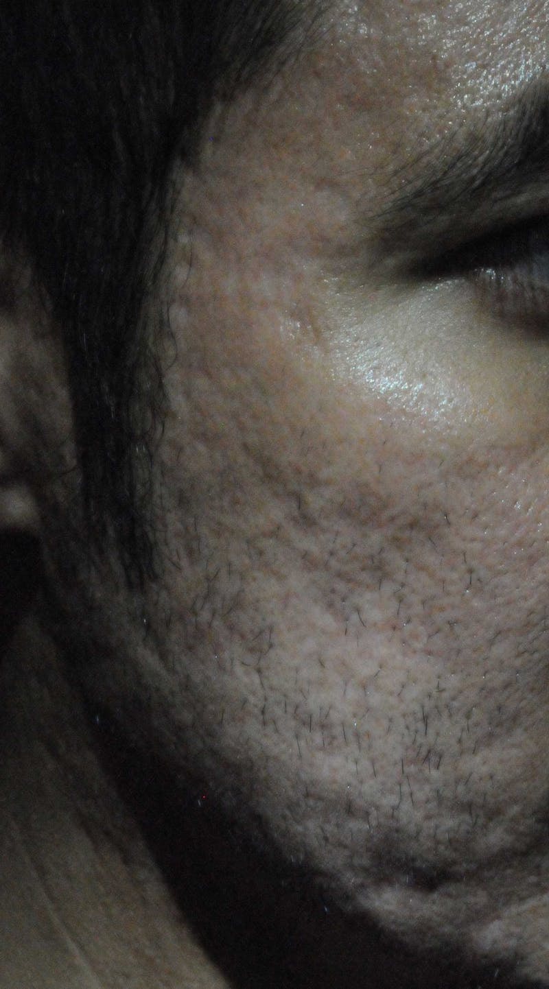 Acne Scar Treatment Before & After Gallery - Patient 250389 - Image 16