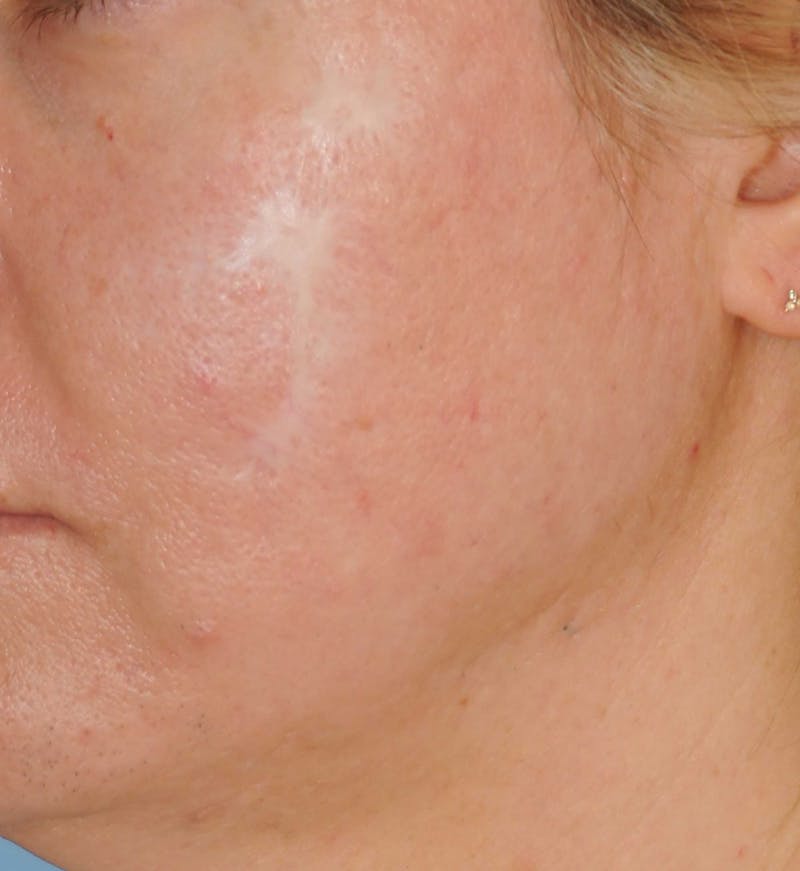 Acne Scar Treatment Before & After Gallery - Patient 521562 - Image 1