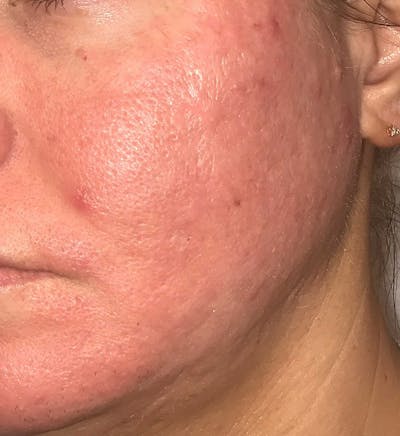Acne Scar Treatment Before & After Gallery - Patient 521562 - Image 2