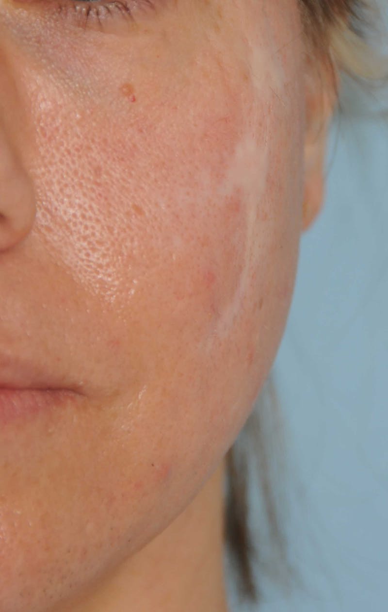 Acne Scar Treatment Before & After Gallery - Patient 521562 - Image 3