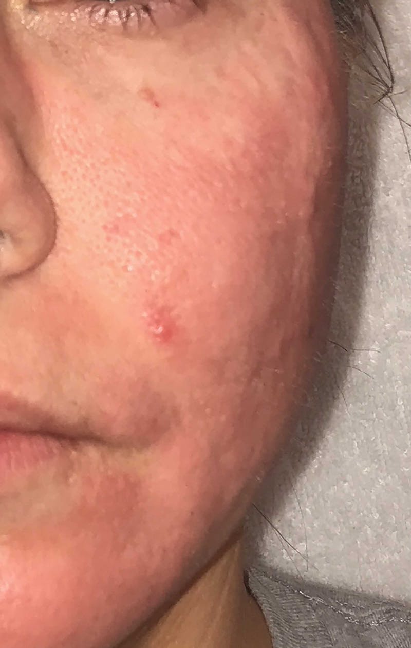 Acne Scar Treatment Before & After Gallery - Patient 521562 - Image 4
