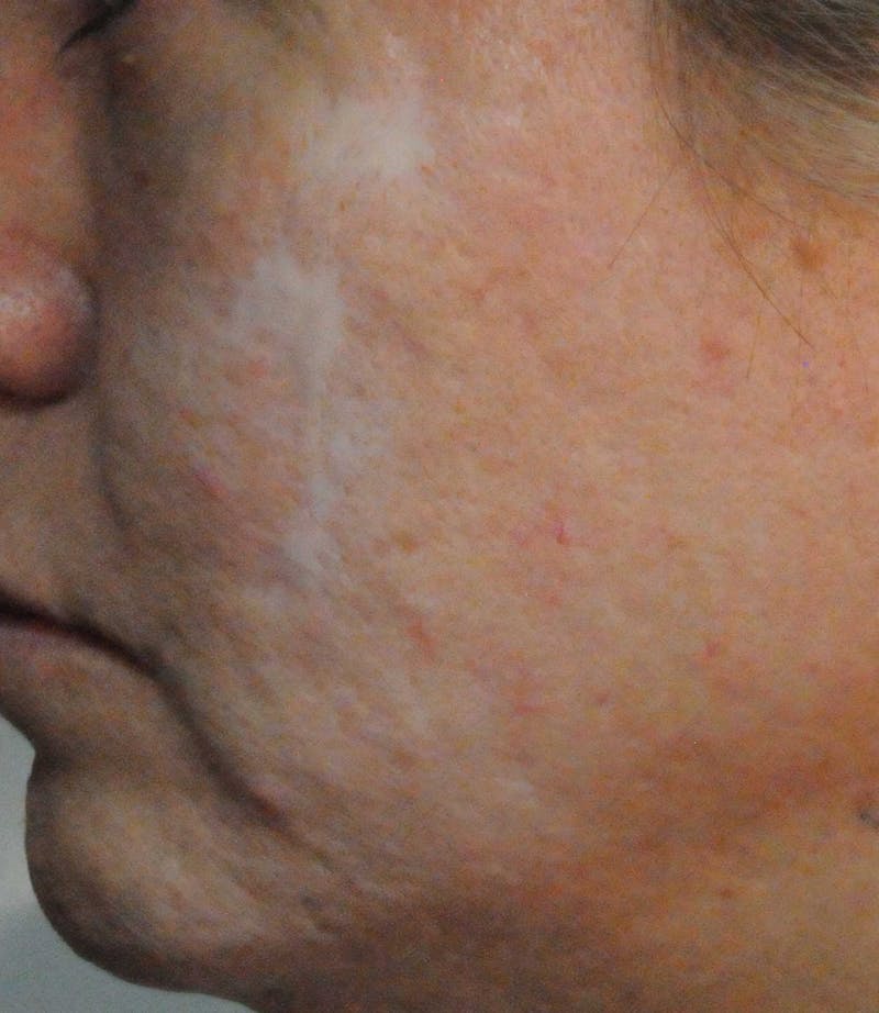 Acne Scar Treatment Before & After Gallery - Patient 521562 - Image 5