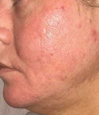Acne Scar Treatment Before & After Gallery - Patient 521562 - Image 6