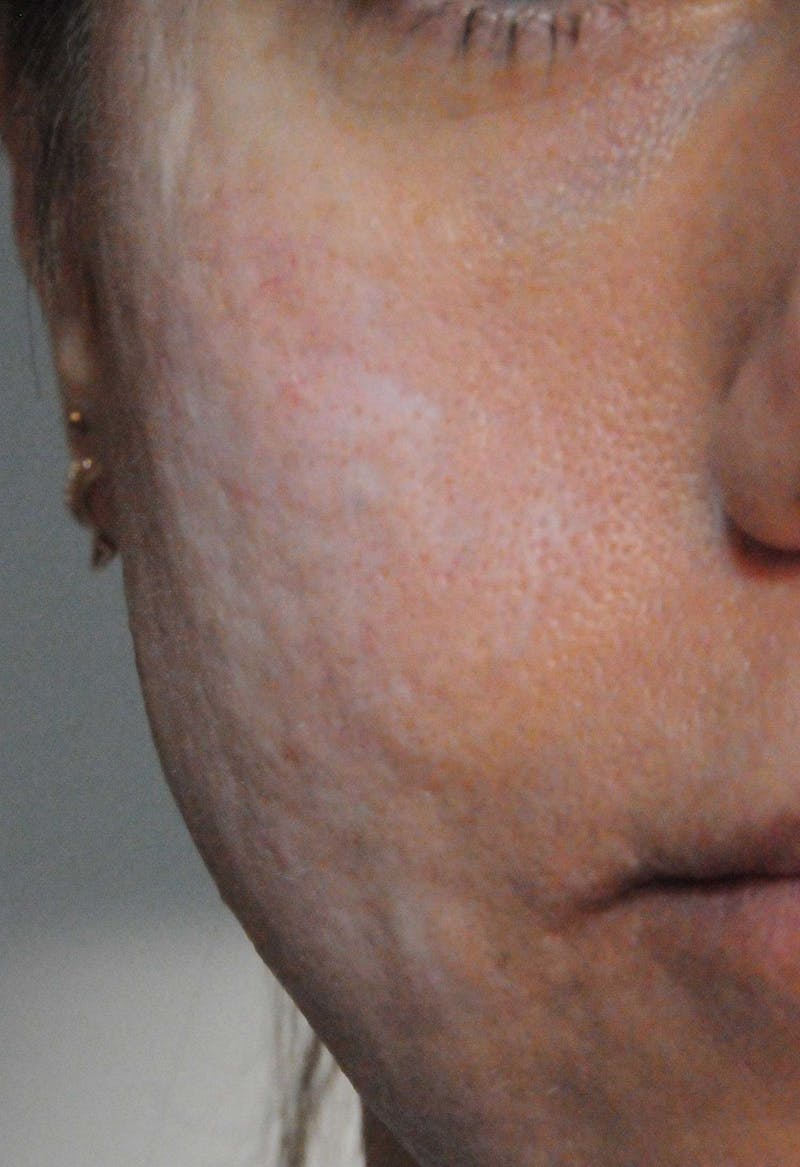 Acne Scar Treatment Before & After Gallery - Patient 521562 - Image 7