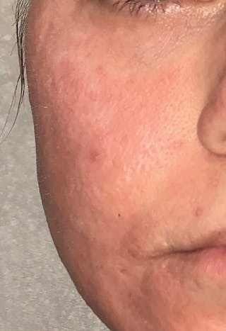 Acne Scar Treatment Before & After Gallery - Patient 521562 - Image 8