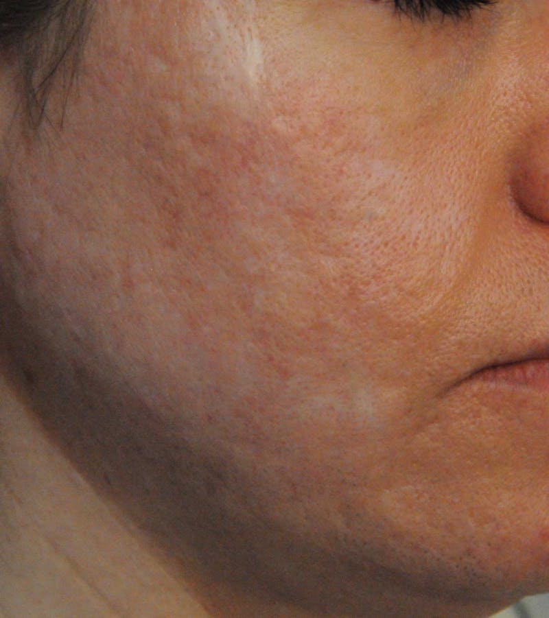 Acne Scar Treatment Before & After Gallery - Patient 521562 - Image 9