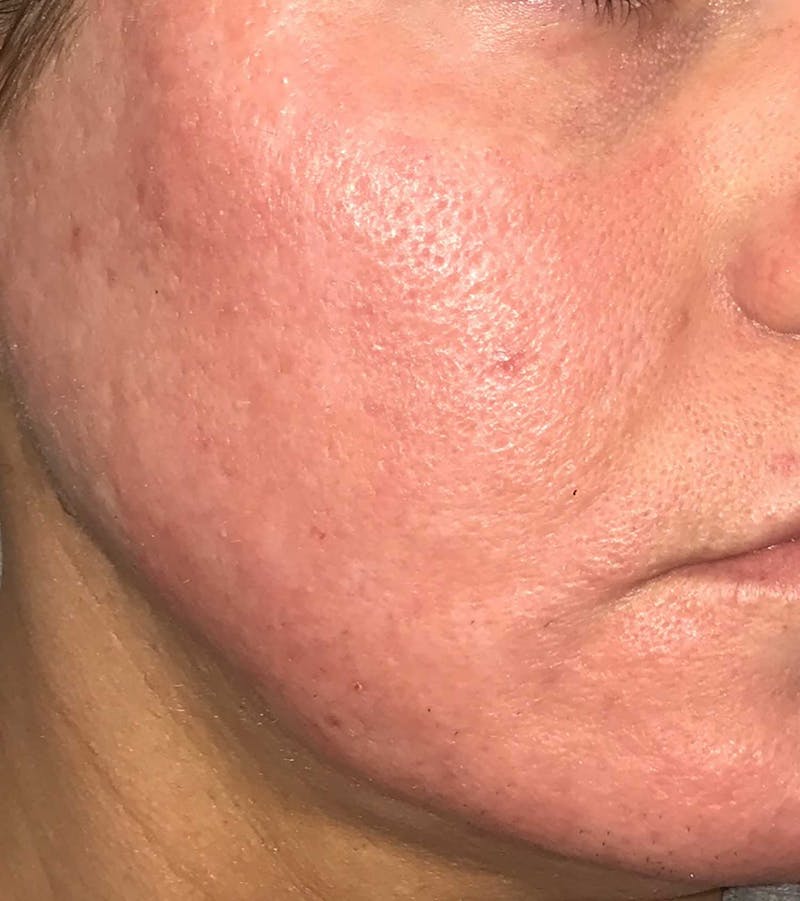 Acne Scar Treatment Before & After Gallery - Patient 521562 - Image 10