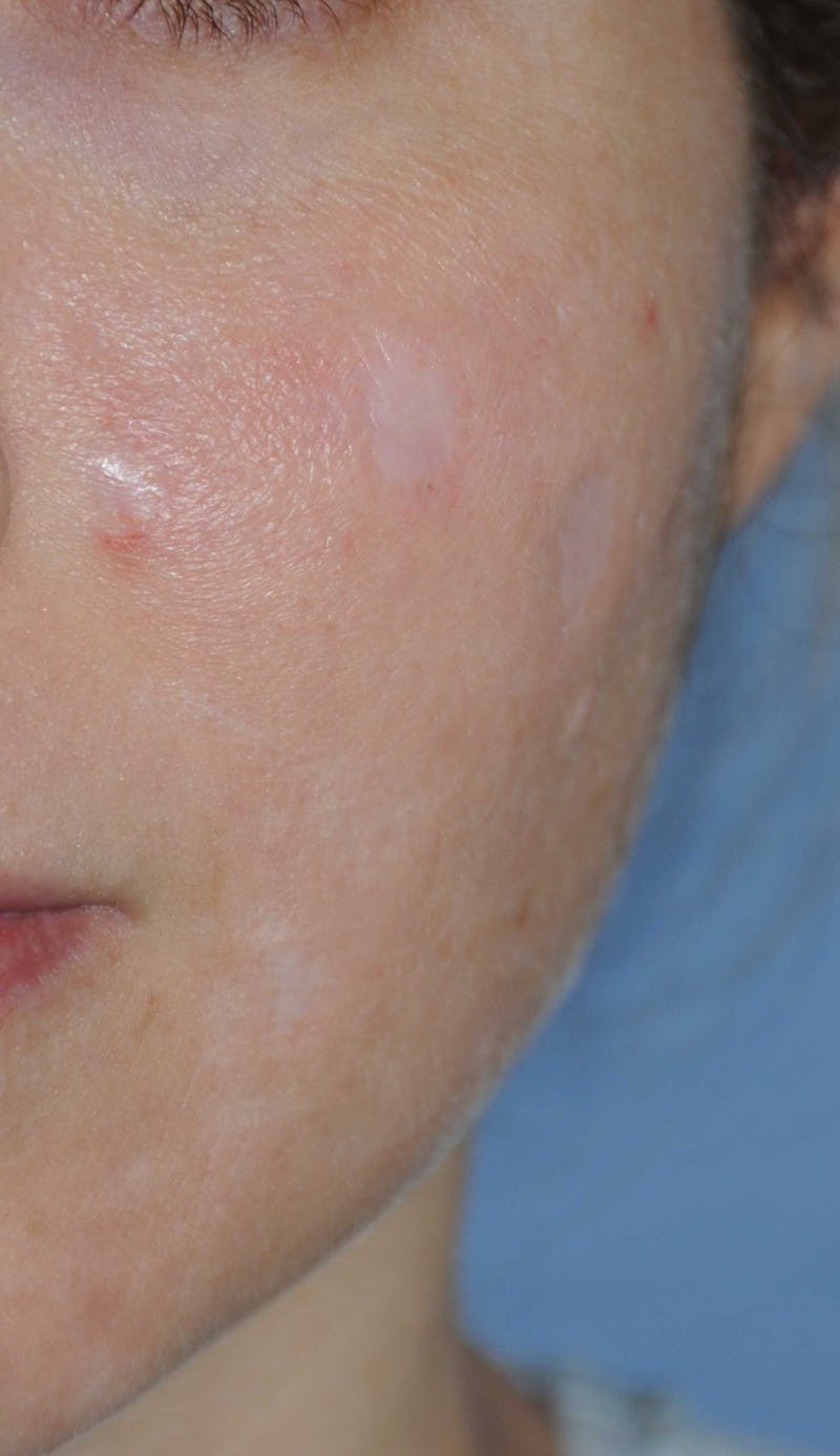 Acne Scar Treatment Before & After Gallery - Patient 381695 - Image 1