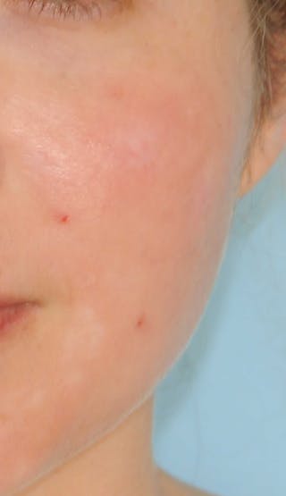 Acne Scar Treatment Before & After Gallery - Patient 381695 - Image 2