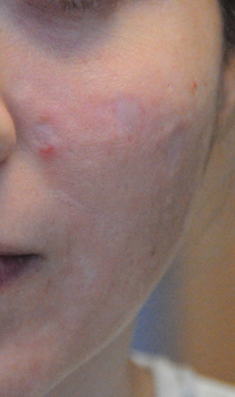 Acne Scar Treatment Before & After Gallery - Patient 381695 - Image 3