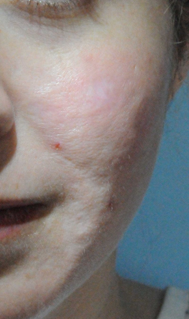Acne Scar Treatment Before & After Gallery - Patient 381695 - Image 4