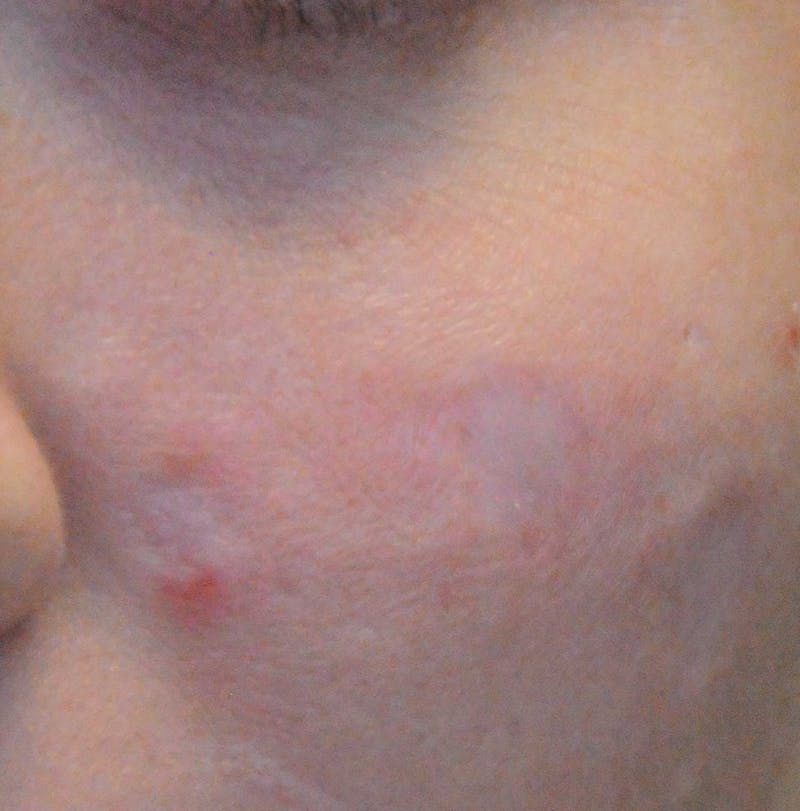Acne Scar Treatment Before & After Gallery - Patient 381695 - Image 5