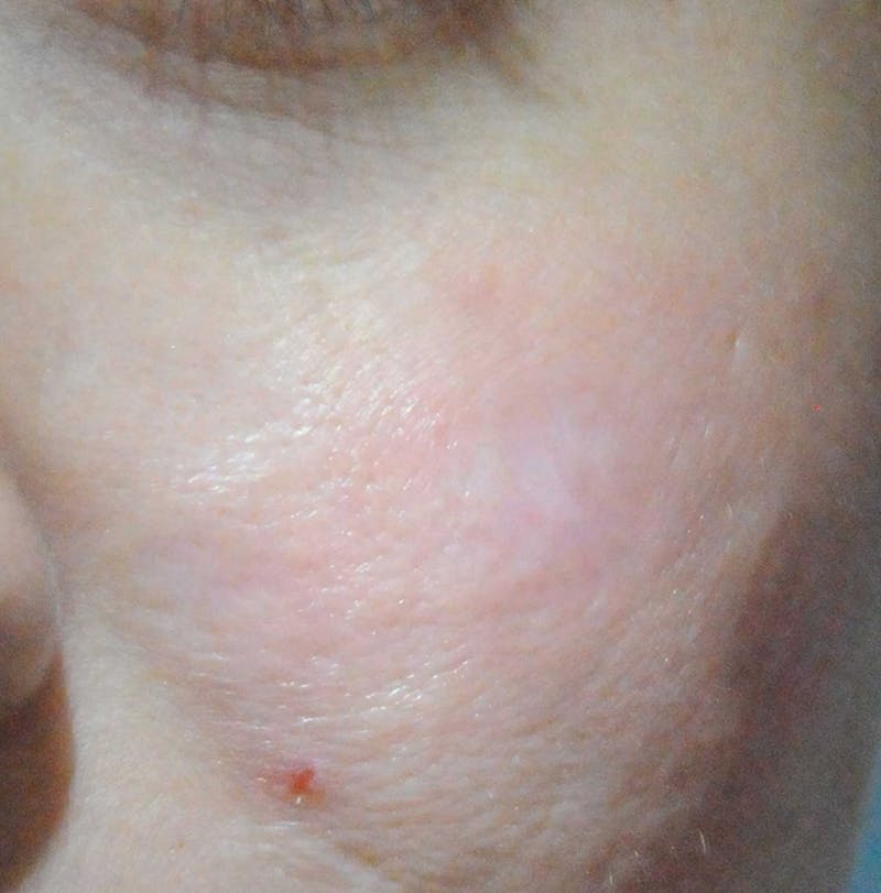 Acne Scar Treatment Before & After Gallery - Patient 381695 - Image 6