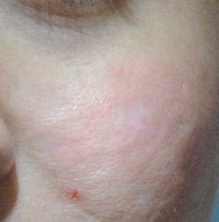 Acne Scar Treatment Before & After Gallery - Patient 381695 - Image 6