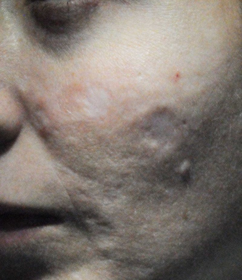 Acne Scar Treatment Before & After Gallery - Patient 381695 - Image 7