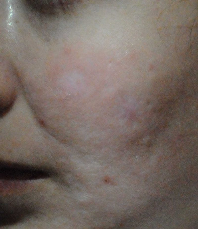 Acne Scar Treatment Before & After Gallery - Patient 381695 - Image 8