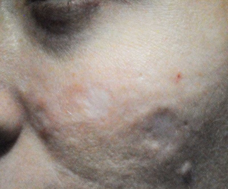 Acne Scar Treatment Before & After Gallery - Patient 381695 - Image 9