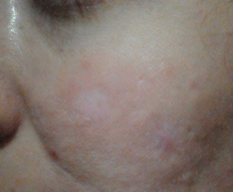 Acne Scar Treatment Before & After Gallery - Patient 381695 - Image 10