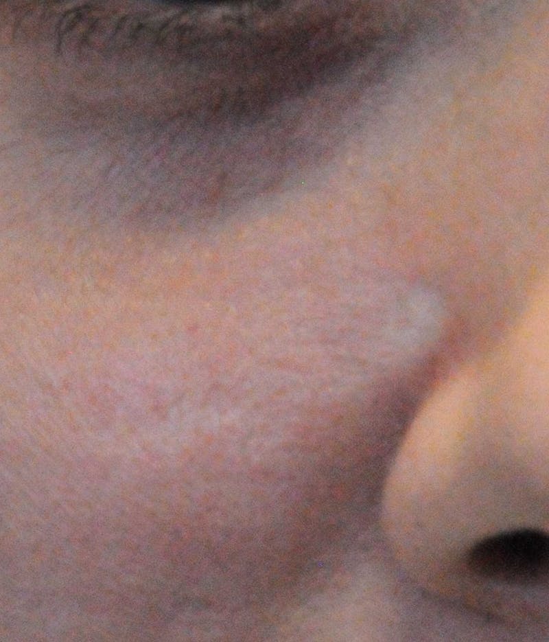 Acne Scar Treatment Before & After Gallery - Patient 381695 - Image 11