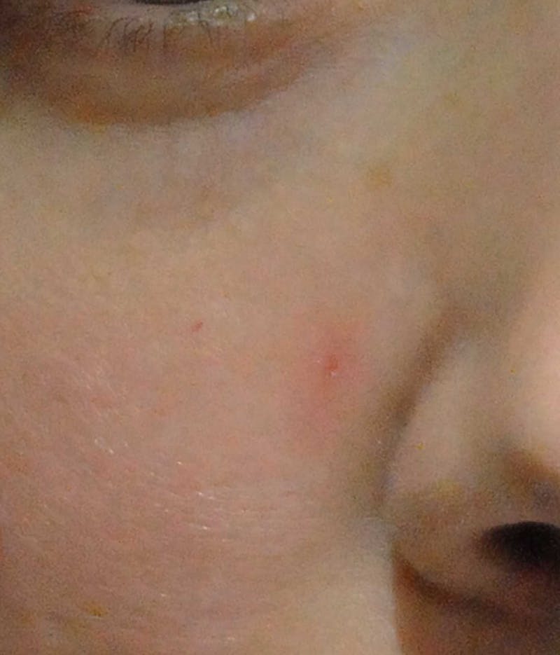 Acne Scar Treatment Before & After Gallery - Patient 381695 - Image 12