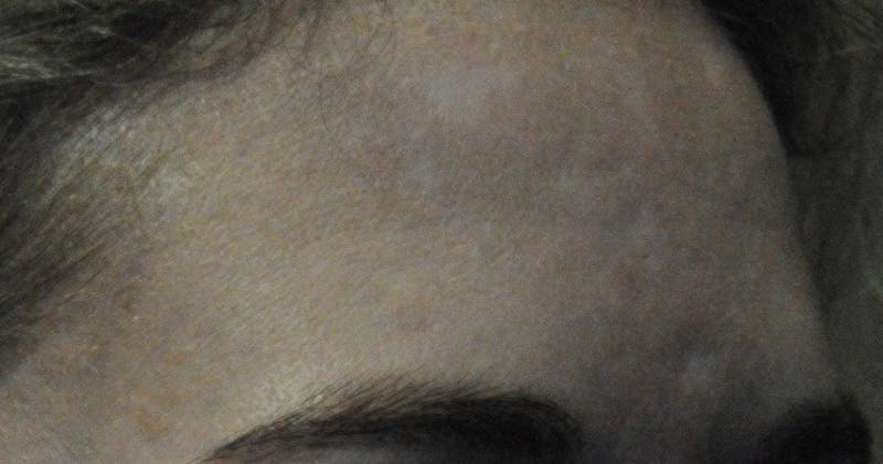 Acne Scar Treatment Before & After Gallery - Patient 381695 - Image 13