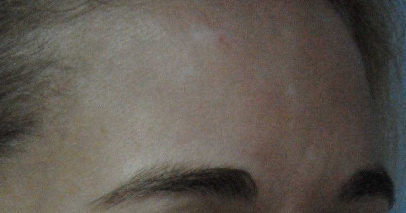 Acne Scar Treatment Before & After Gallery - Patient 381695 - Image 14