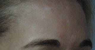 Acne Scar Treatment Before & After Gallery - Patient 381695 - Image 14