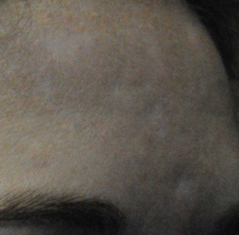 Acne Scar Treatment Before & After Gallery - Patient 381695 - Image 15