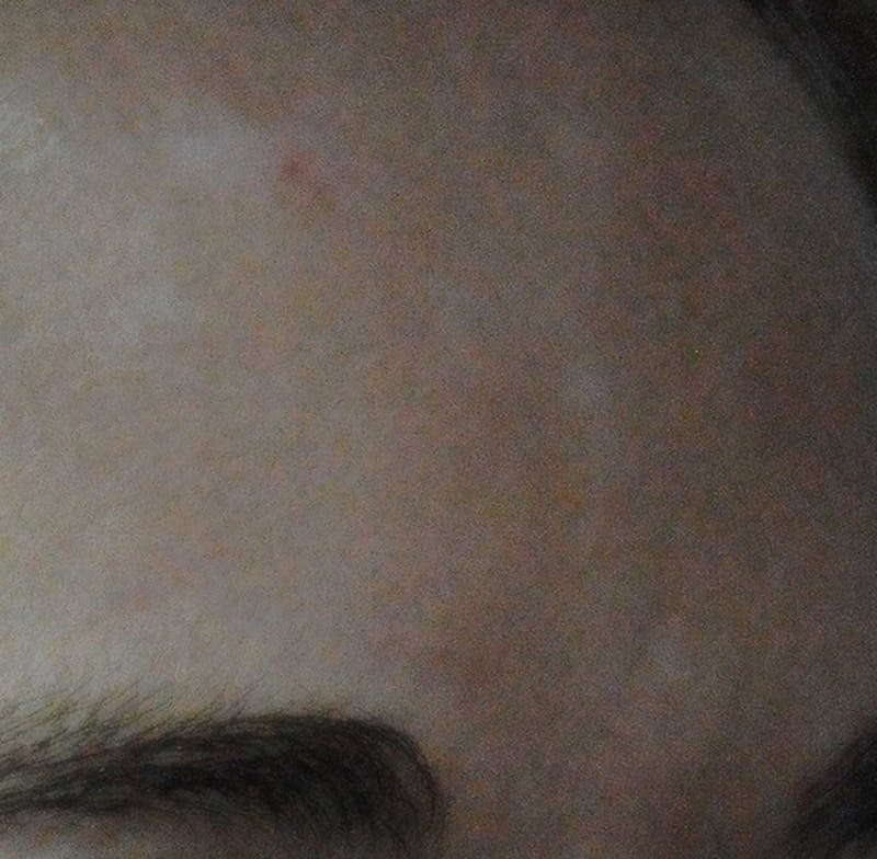 Acne Scar Treatment Before & After Gallery - Patient 381695 - Image 16