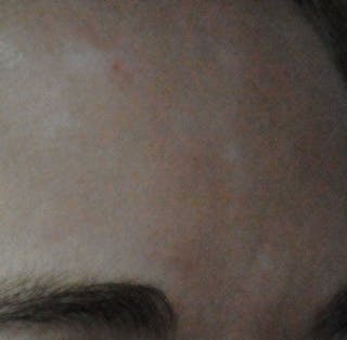 Acne Scar Treatment Before & After Gallery - Patient 381695 - Image 16