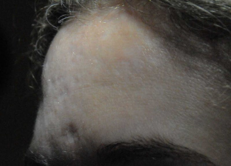 Acne Scar Treatment Before & After Gallery - Patient 381695 - Image 17