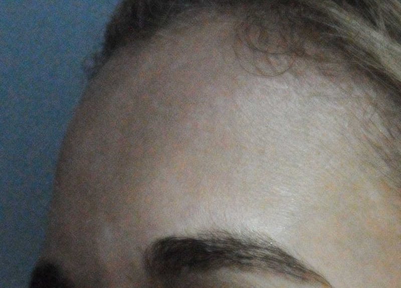 Acne Scar Treatment Before & After Gallery - Patient 381695 - Image 18