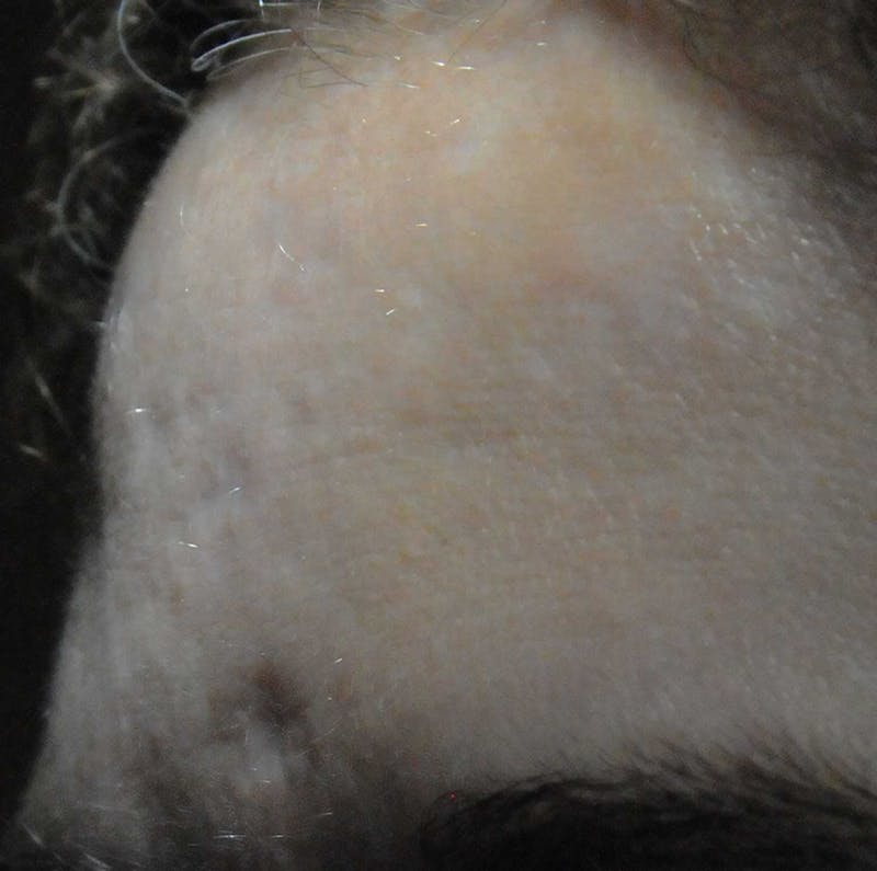 Acne Scar Treatment Before & After Gallery - Patient 381695 - Image 19