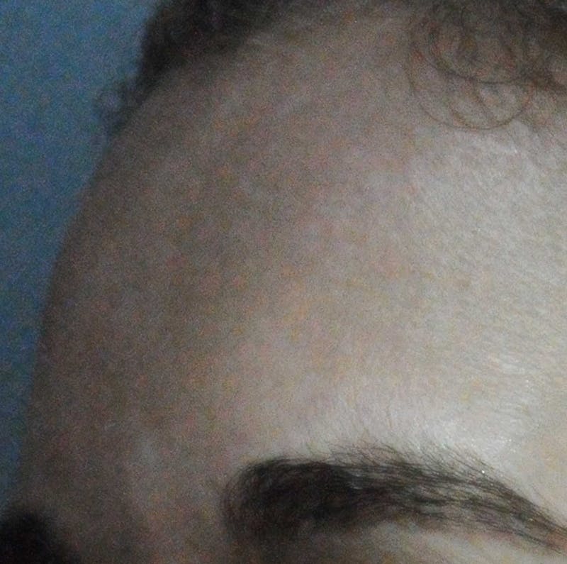 Acne Scar Treatment Before & After Gallery - Patient 381695 - Image 20