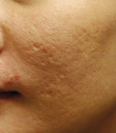 Acne Scar Treatment Before & After Gallery - Patient 389960 - Image 1
