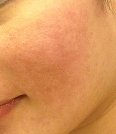 Acne Scar Treatment Before & After Gallery - Patient 389960 - Image 2