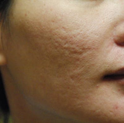 Scar Revision Before & After Gallery - Patient 428968 - Image 1