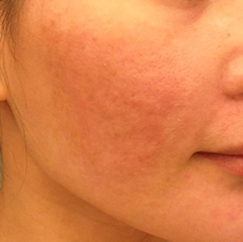 Scar Revision Before & After Gallery - Patient 428968 - Image 2