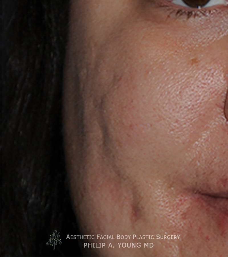 Acne Scar Treatment Before & After Gallery - Patient 414487 - Image 1