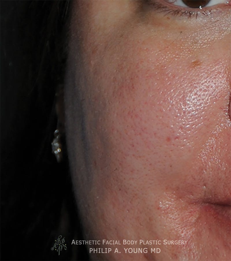 Acne Scar Treatment Before & After Gallery - Patient 414487 - Image 2
