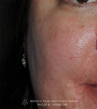 Acne Scar Treatment Before & After Gallery - Patient 414487 - Image 2